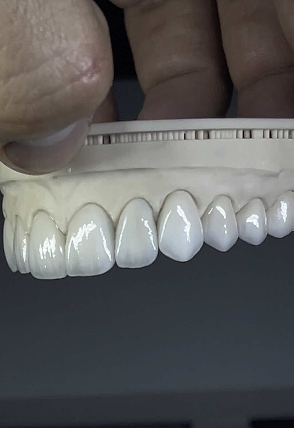 Emax press 🦾 #Tpd #dentalart #dentistry #tecnicadental #carillas #odontologiaestetica #esteticadental #dentallaboratory #impresion3d 