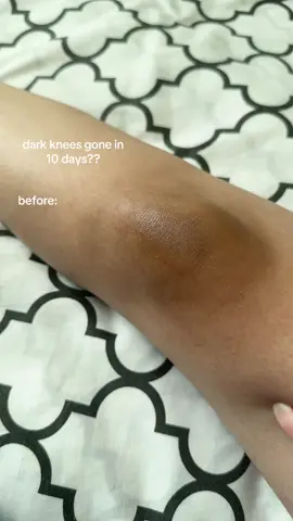 Dark knees gone🤭 product name: KSECRET - SEOUL 1988 Serum: Retinal Liposome 2% + Black Ginseng You can order on Yesstyle! U can use reward code: EB898989 and coupon code: MILKYDEW10 at checkout for discount #darkknees #darkspotsolution #whiteningserum #whiteningskincare #brighteningskincare #darkkneesolution #retinal #retinalcream #retinalskincare #bestkoreanskincare #trendingkoreanskincare #viralkoreanskincare #viralskincareproducts #trendingskincareproducts #koreanskincare #ksecret #darkspotserum