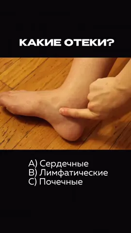 Как думаете?  Если отеки увеличиваются к вечеру, отечность начинается именно с ног, плотная.  Ваш вариант?