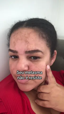 #melasma #melasmanuncamais #melasmaskincare #melasmatreatment 
