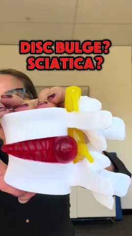 Spinal decompression can help with disc bulges, sciatica and any form of back pain.  #spinaldecompression #discherniation #LowerBackPain #chiropractic #CompleteCityHealth #chirosydney 