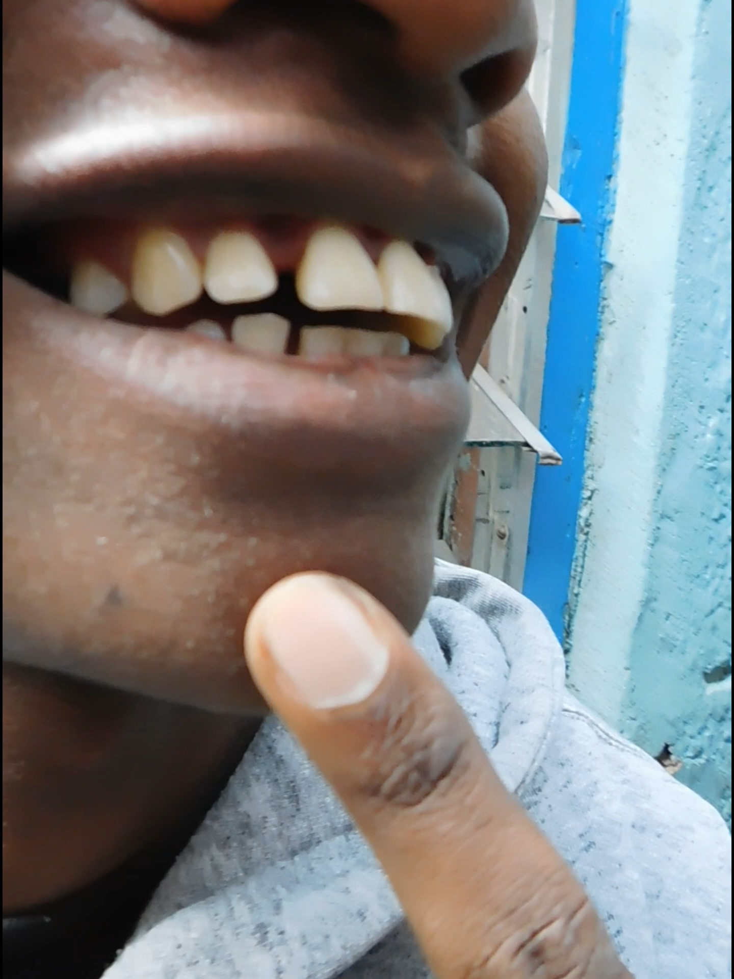 braces progress after 1 week thank you @proudsmiles4 #braces #teeth #fyp #foryoupage