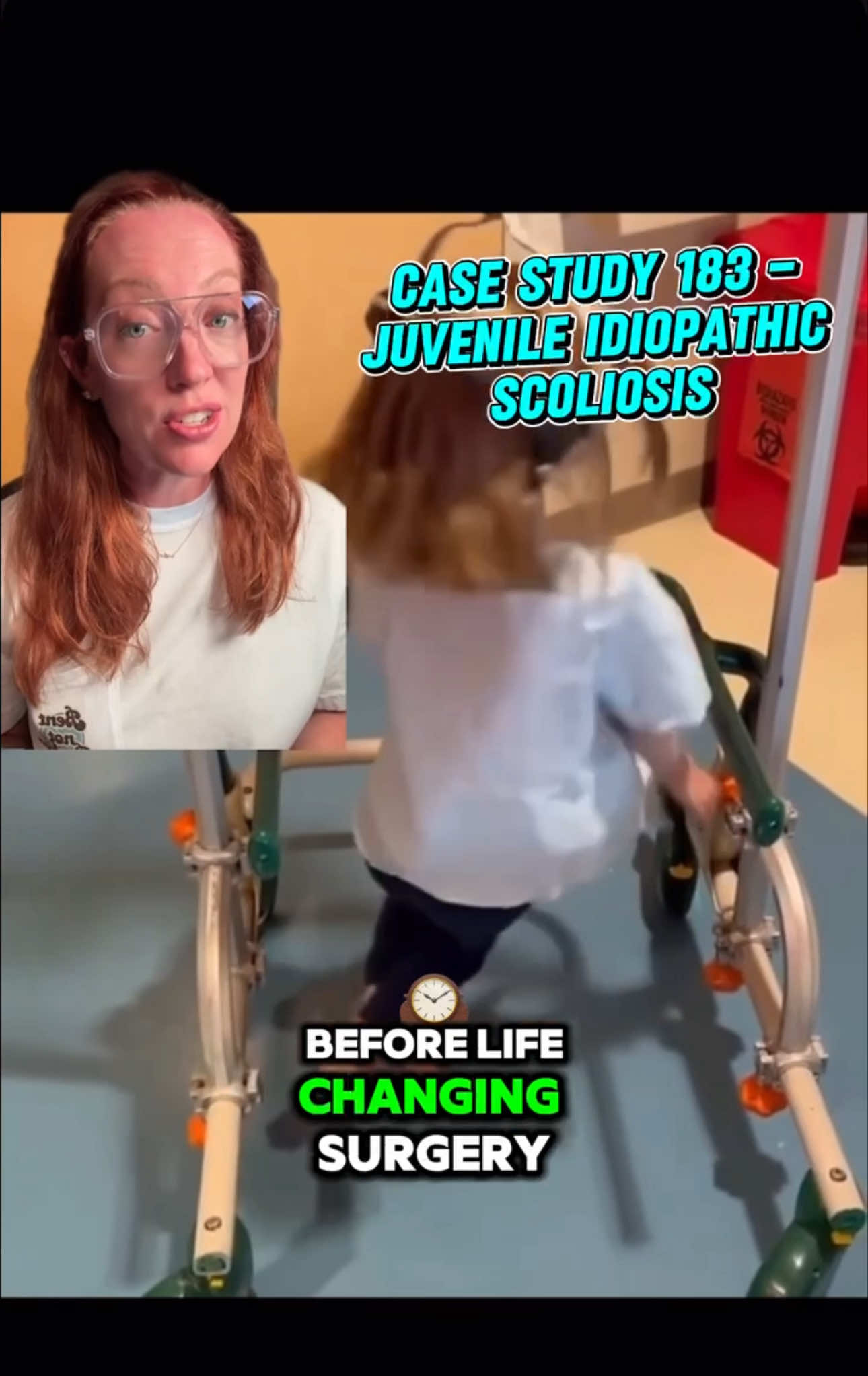 Case Study 183: Juvenile Idiopathic Scoliosis In this video, we explore a powerful case of juvenile idiopathic scoliosis (JIS)—a rare but serious form of scoliosis diagnosed between ages 4–10. Our patient, an 8-year-old girl, presented with a rapidly progressing 108° spinal curve. ✨ What makes JIS different? Unlike adolescent scoliosis, JIS can be more aggressive and often requires early intervention to prevent lung and spinal cord complications. Treatment in this case included halo gravity traction followed by spinal fusion surgery—a life-changing journey of strength and resilience. 🧠 This is more than just a curve. It’s a condition that can affect a child’s growth, breathing, and quality of life. Early detection = better outcomes. 🎗️June is Scoliosis Awareness Month—let’s honor the strength of these young warriors. #CaseStudy183 #JuvenileIdiopathicScoliosis #ScoliosisAwareness #PedsOrtho #HaloTraction #SpineSurgery #BentNotBroken #ladyspinedoc #sundaycasestudy 