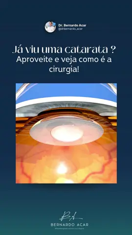 👁️ Já imaginou enxergar o mundo como se estivesse sempre olhando por um vidro embaçado? 😶‍🌫️ Essa é a realidade de quem tem catarata, uma doença ocular que provoca a opacidade do cristalino — a lente natural dos nossos olhos. O resultado? 📉 Visão embaçada 📖 Dificuldade para ler 🚗 Problemas para dirigir 😕 Até reconhecer rostos pode ser um desafio… A catarata é a principal causa de cegueira reversível no mundo, segundo a OMS!Costuma evoluir de forma lenta e silenciosa… muita gente só descobre quando a visão já está muito comprometida. 👉 Por isso, o diagnóstico precoce faz toda a diferença! 👨‍⚕️ Consulte um oftalmologista regularmente e mantenha seus exames em dia. 📲 Se identificou? Agende uma avaliação. #Catarata #VisaoEmbacada #SaudeOcular #Oftalmologia #PrevinaACegueira #CatarataTemTratamento #CirurgiaDeCatarata #CuidadoComOsOlhos #DiagnosticoPrecoce #saudedosolhos 