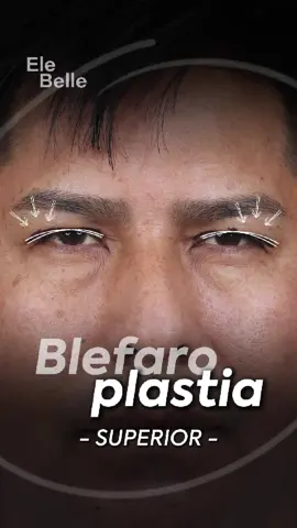 🔹 Mirada más abierta, párpados más ligeros La blefaroplastia superior elimina el exceso de piel que cae sobre el párpado y apaga tu expresión. El resultado: una mirada más fresca, natural y descansada. 📍 Agenda tu evaluación personalizada. #elebelle #RejuvenecimientoFacial #Tacna #peru #belleza #estetica #blefaroplastia #rejuvenecimiento 