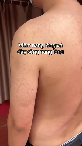 Dày sừng nang lông có lá uống và ngâm tại nhà cho các bác @Thị Tuyến DC 35(2) #viêmdacơđịa #vẩynến #viêmdatiếtbã #viêmnanglông 