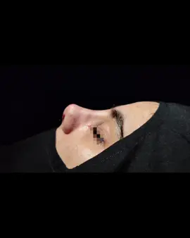 ‎‎د.پێشڕەو خالد ‎پسپۆڕی نەشتەرگەری قوڕگ و لووت و گوێ و جوانکاری لووت و گوێ ‎دکتۆرا(بۆرد) لە نەشتەرگەری و نەخۆشیەکانی قورگ و لووت و گوێ ‎کاندیدی دکتۆرا لە پسپۆری وردی نەشتەرگەری ژێرکاسەی سەر بەنەنازورو نەخۆشیەکانی لووت _________________________________________________________ ‎نەشەرگەری جوانکاری لووت و گوێ ‎نەشتەرگەری جیوبەکانی لووت بەناظور ‎نەشتەرگەری کردنەوەی بۆری فرمێسک بەناظور ‎نەشتەرگەری دانانەوەی پەردە گوێ و گوێی ناوەراست ‎نەشتەرگەری سەرومل __________________________________________________________________📞  ٠۷۷٠٥۷٤٤۲٤۲       ٠۷٥٠۱۳۸٦۲٦۱ ‎__________________________________________________________________🏩🏩رانیە شەقامی گشتی تەلاری پزیشکی سینا #beniöneçıkart #beauty #foryoupage #plastic #belgium #septorinoplasti #rhinoplastie #rhinoplastyconvention #erbilrhinoplasty #kurdistan #dubai #for #froyou #usa #slimani_سليماني #ranya 
