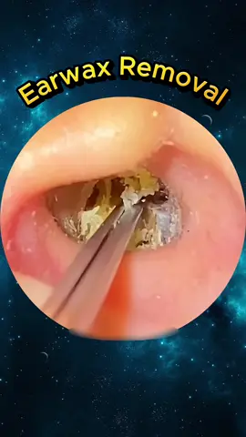 You will regret it if you skip this deep cleaning step. #earwaxcleaning #earwax #doctor #ears #asrm #DIY 