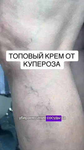 Куперофаг — тот случай, когда даже не хочется говорить, чтобы не раскупили. 😅 Но поделюсь, потому что он реально работает. Хэштеги: #wildberries #секретик #купероз #лучшеевб #розацеа #псориаз #вбтовар #находка #вбпокупка #skincare