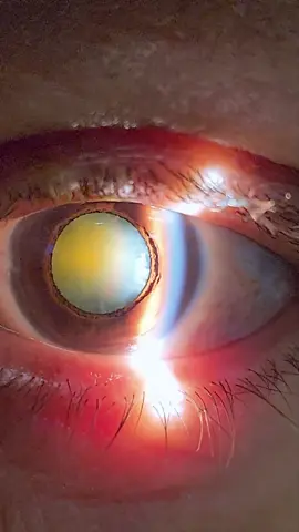 É assim que a gente vê um OLHO com CATARATA