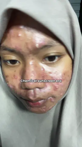 Bagussss bangetttt 😙❤️#scora #sunscreen #scorasuncreen #scoraofficial #scora #acneskincare #acnejourney #acne #acneprone #acneskin 