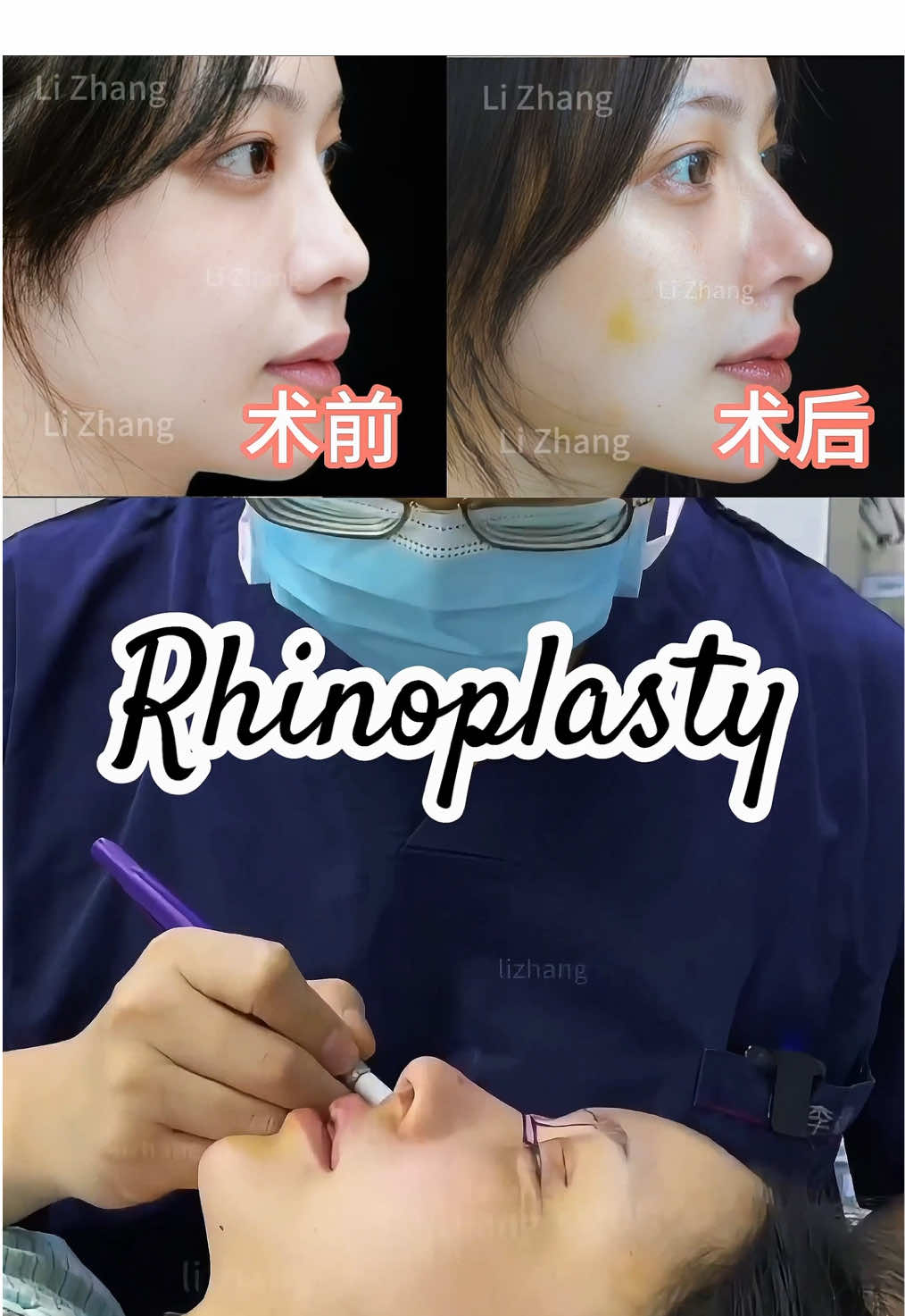 #鼻整形 #隆鼻 #整形 #整容 #suamuihong #rhinoplasty #nose #肋骨鼻 #鼻子 #逆袭 #医美 