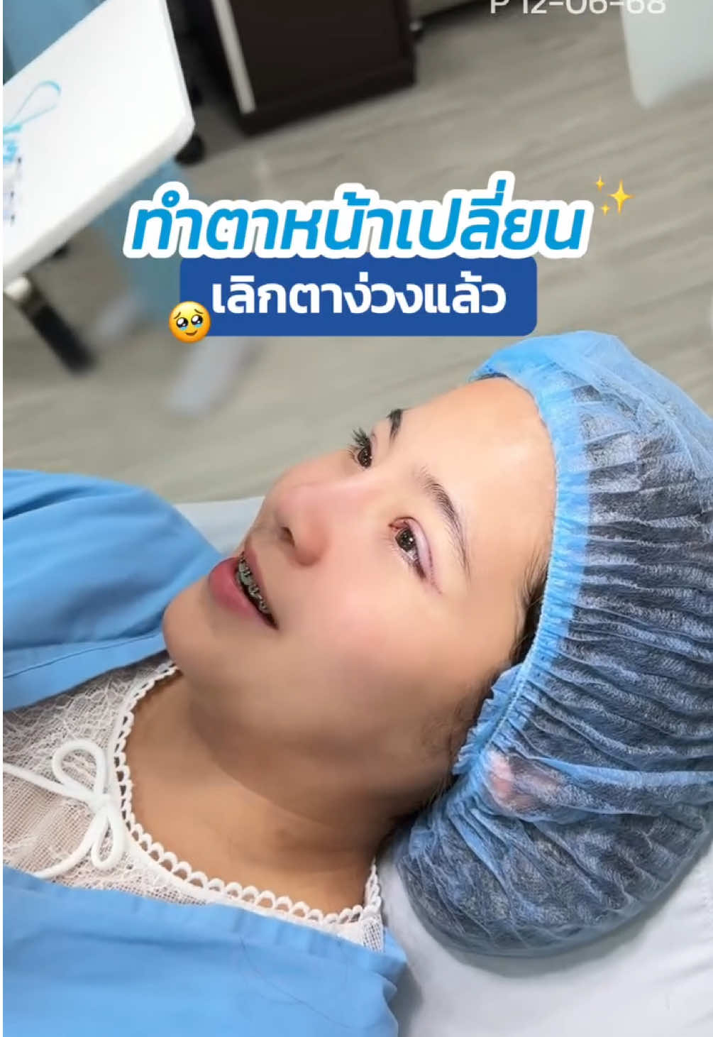 ทำตาหน้าเปลี่ยน ✨ เลิดตาง่วงแล้ว 🥹 #รีวิวตาสองชั้น #skyclinic #หมอสกาย #จักษุแพทย์ #สกายคลินิก #ศัลยกรรมตา #ทำตาที่ไหนดี #กล้ามเนื้อตาอ่อนแรง 