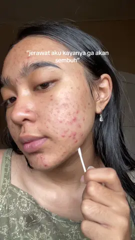 YOU kalo ngeluarin produk gapernah gagal🤍 #jeratjerawat 