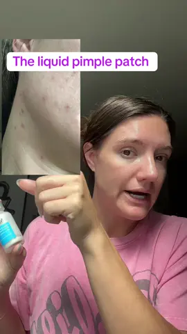Liquid pimple patch. #liquidpimplepatch #murad #acnetreatment #acneproneskin #acnehelp #tiktokshopcreatorpicks @Murad Skincare 