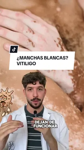 El vitíligo es un trastorno cutáneo caracterizada por la pérdida de pigmento en la piel, formando manchas blancas. Se debe a la destrucción de melanocitos, células responsables de la pigmentación, probablemente por un mecanismo autoinmune. Puede estar asociado a otras enfermedades como el hipotiroidismo. El tratamiento incluye corticoides tópicos, inhibidores de calcineurina, fototerapia, corticoterapia y nuevos fármacos actuales! #manchas #vitiligo #manchasblancas #vitiligobeauty #vitiligotreatment #creatorsearchinsights 