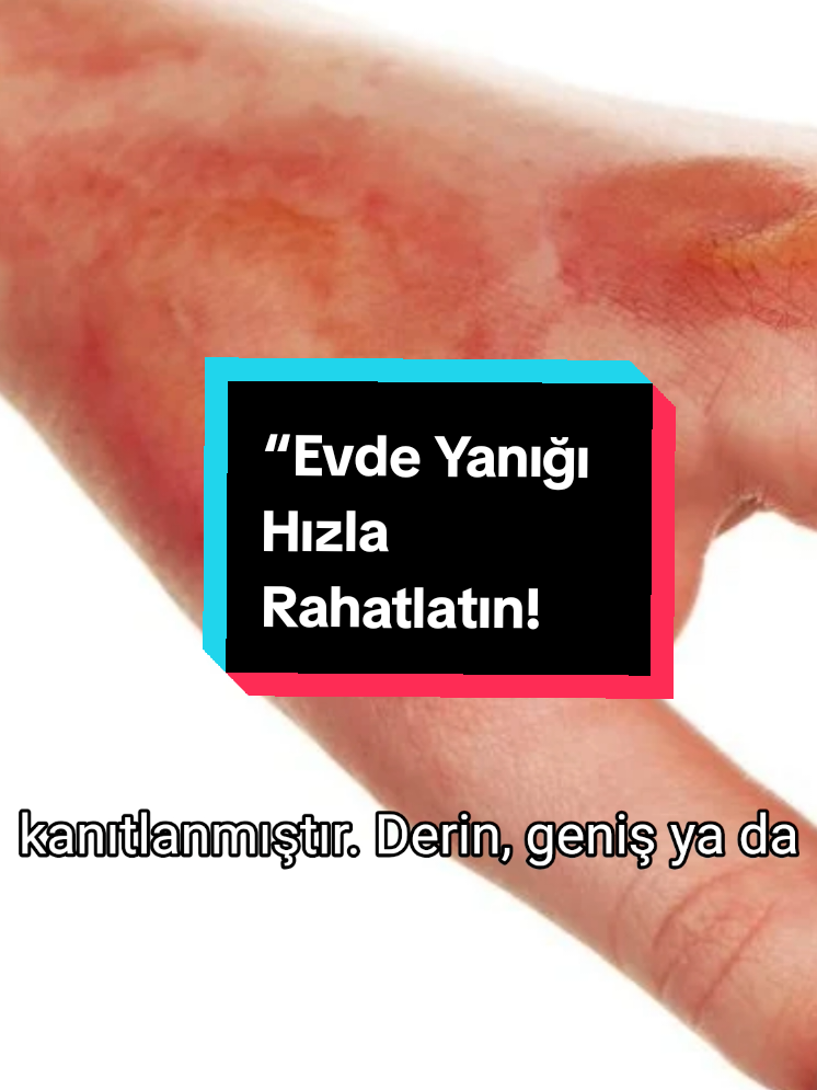 “Evde Yanığı Hızla Rahatlatın: Balmumu+ Zeytinyağı Tarifli Çözüm ! #evdeyanık #yanıktedavisi #homeremedies #BilgileriKeşfedelim ''Bilgileri Keşfedelim