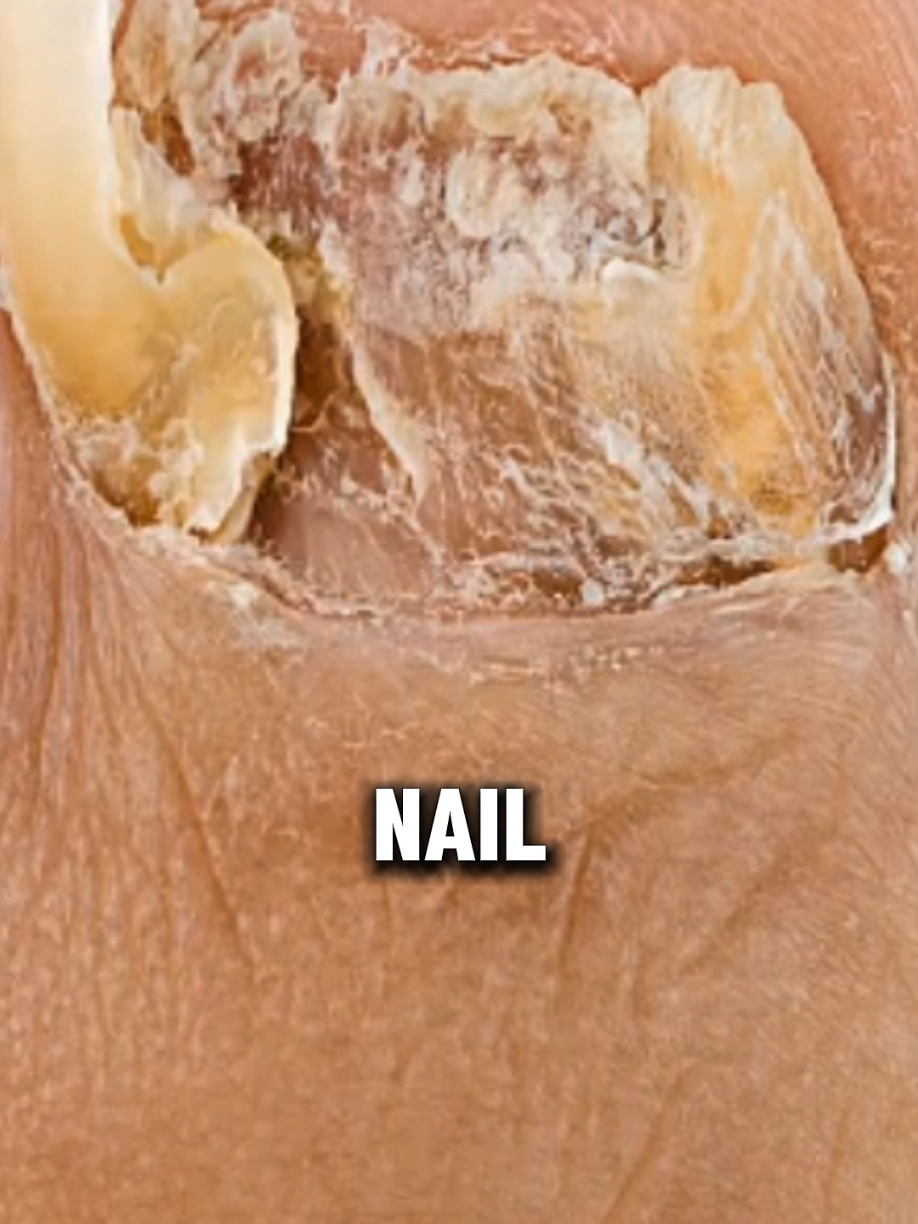 Garlic + Baking Soda + Vinegar 🧄💅 Treat Nail Fungus Naturally at Home!... #NailFungusRemedy #DIYNailCare #NaturalHealing #GarlicForHealth #HomeCure #TikTokHealthHack #NailCareTips #BakingSodaHack #VinegarRemedy #ViralWellnessTip
