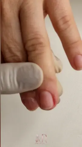 Ferir a cliente é algo que tem que ser evitado , porém pode acontecer. E para facilitar nosso trabalho nada melhor do que um produto eficaz para nos ajudar.  #manicure #unhas #hemoliq #profissional #nordestina #manicuretop #unhaslindas #unhasnaturais #manicuresincera #autocuidado 