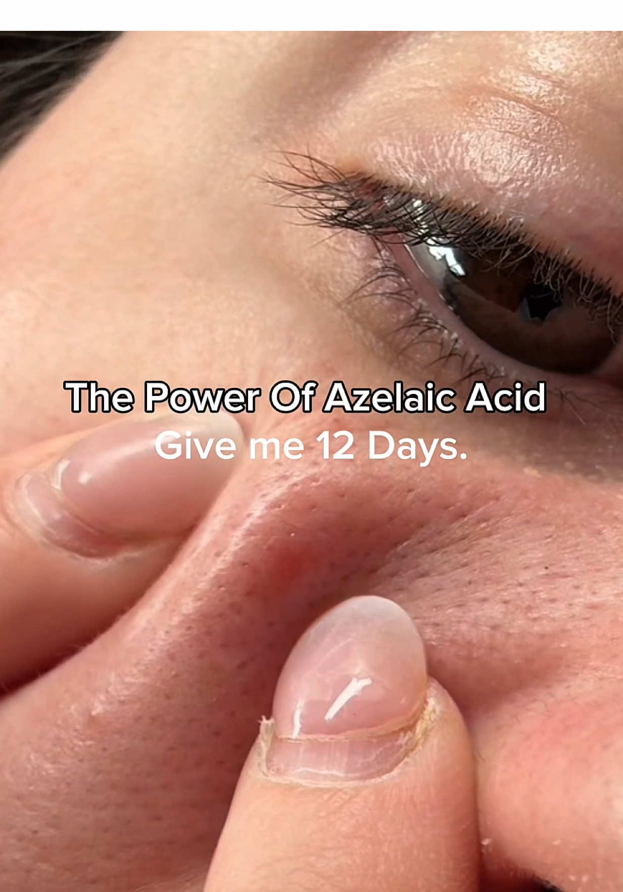 The power of Azelaic Acid 👏🏻 Using Anua Azelaic Acid +10
