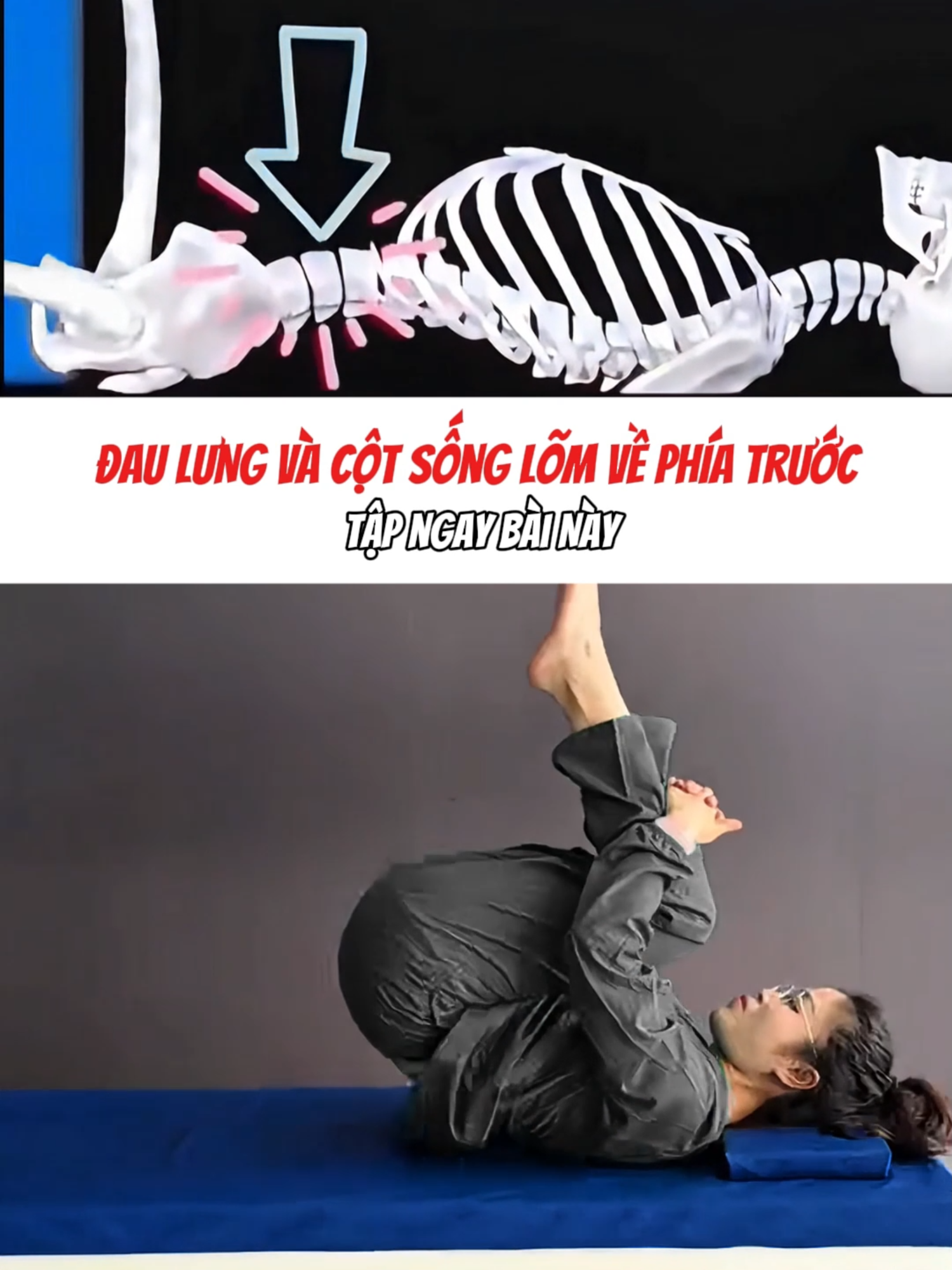 Đau lưng và cột sống lõm về phía trước. Tập ngay bài này #daumoilung #baitaptainha #trilieuvientam #xuhuong