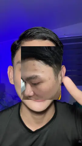 get ready to say goodbye to blemishes with this acne drying lotion from @DR LEO OFFICIAL STORE PH @Dr.Leo-USA #drleoph #acnebuster #acnefighter #acnetreatment #skintok #skincareroutine #stevenhitosis #foryou 