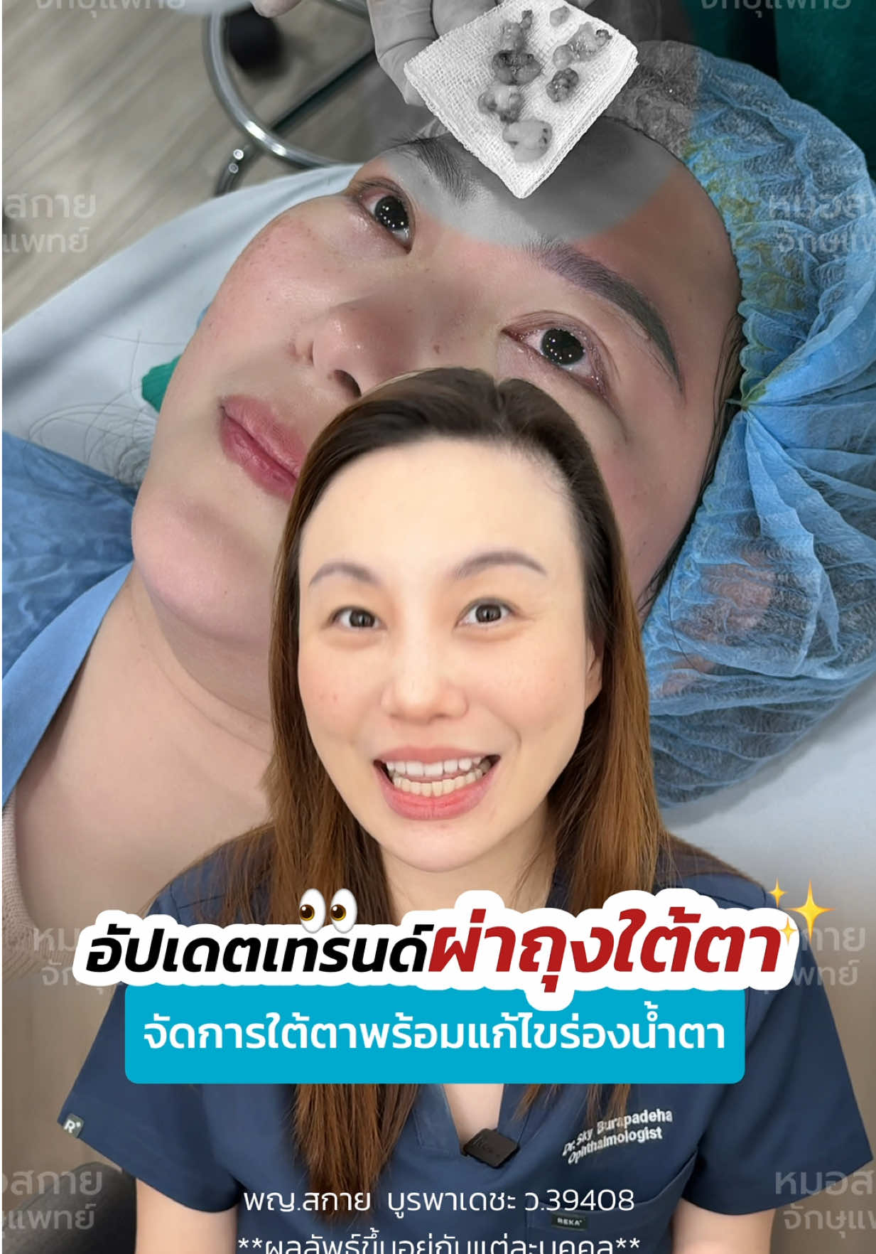 อัปเดตเทรนด์ #กําจัดถุงใต้ตา ⁉️ #ถุงใต้ตา #ตัดถุงใต้ตา #หมอสกาย #จักษุแพทย์ #ศัลยกรรมตา #skyclinic #สกายคลินิก   #ทำตาที่ไหนดี