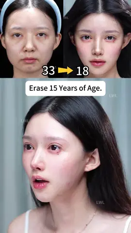 #幼态脸 #注射医美 #轮廓固定# 面部提提升#JuvenileLookingFace#InjectableAesthetics#FacialLift