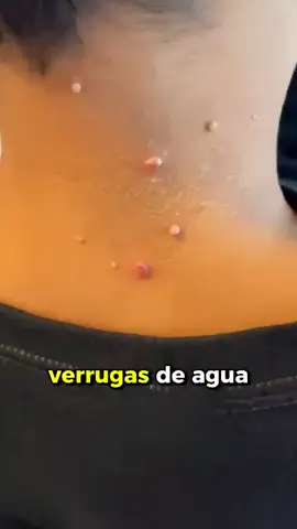 Tag Recede ™ actúa rápidamente desde la primera aplicación. Spray 100% natural con veneno de abeja para una piel limpia y libre de imperfecciones. Las verrugas y lunares no solo afectan tu imagen, también tu autoestima. #compralo en #latiendadeltodo con #enviogratis y #pagaencasa 
