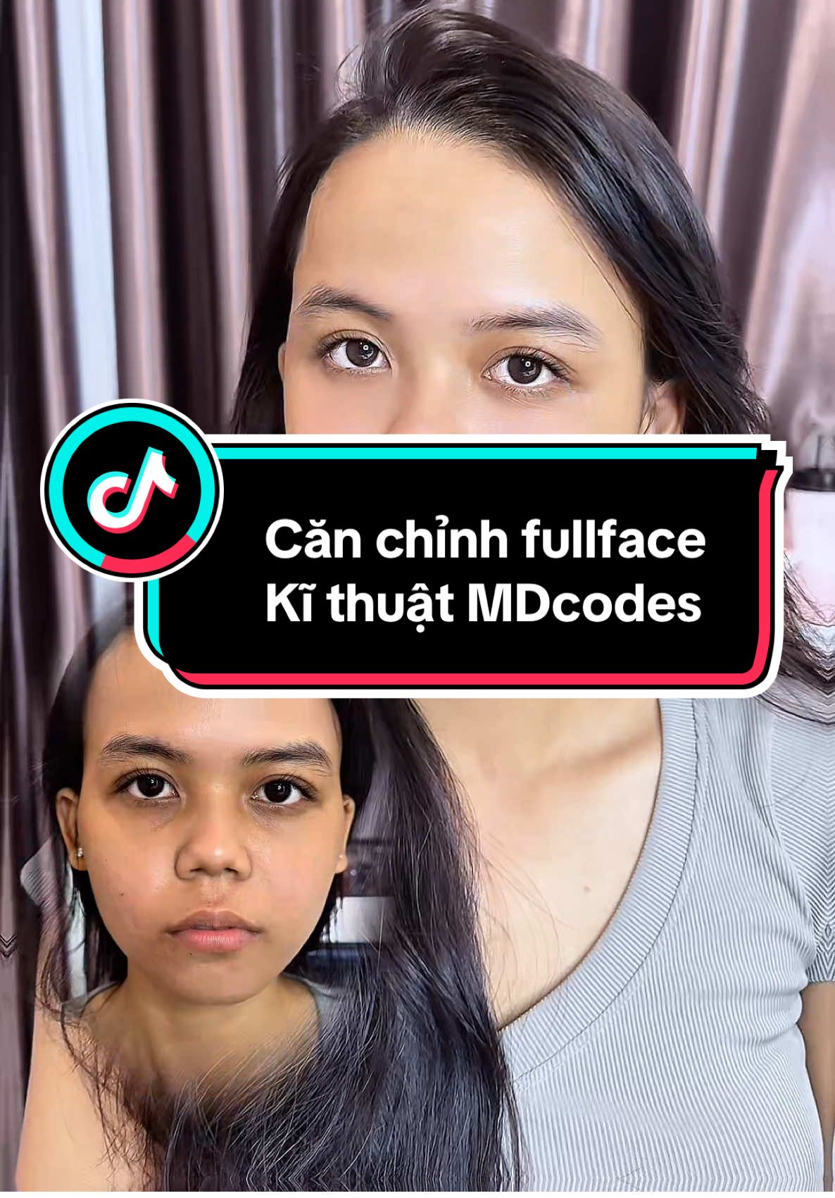 Các bạn đã biết cân chỉnh mặt bằng kĩ thuật MDcodes chưa ? Cùng bs Linh cân chỉnh fullface cho bạn nữ này nhé ! #drphamhailinh #bacsitiemmoidep #canchinhkhuonmat #tiemfulface #mdcodes 