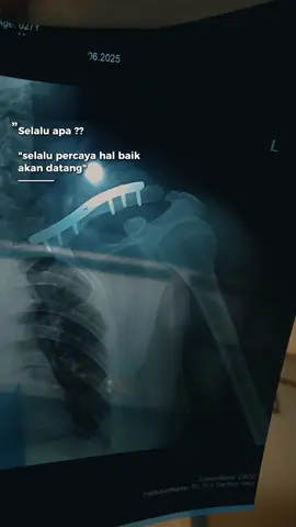 #CapCut #pejuangpatahtulang #clavicula 