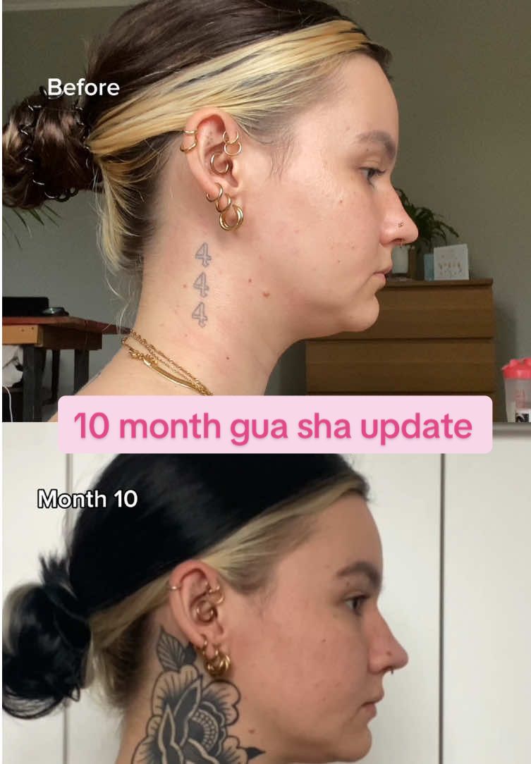 10 month gua sha update #guasha #guasharesults #lymphaticdrainage #fyp #beforeandafter #uktiktok #ukcontentcreator 