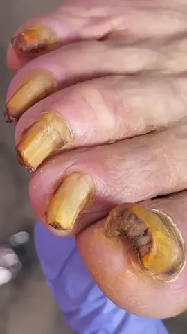 “We Extracted a Monster Toenail… You Won’t Believe This 😱👣” #ingrowntoenail #toenailremoval #ingrowntoenailremoval #podiatry #feetcare #footcare #satisfying #asmr #grossvideos #satisfyingvideo #oddlysatisfying #ingrownnail #toenail #podiatrist #footdoctor #graphiccontent #foryou #fyp #unhasencravadas #unhaencravada #podologia #podologiacomamor #podologiapreventiva #podologiaclinica #podologiainfantil #podologista #beleza #bemestar #podologia #podologo #podologa #unhaencravada #unhasencravadas #unhas #pedicure #unhasdecoradas #unhaslindas #unhasperfeitas #followme #sdvtodos #boramonetizar