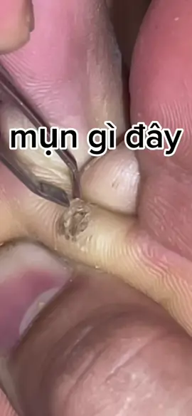 Tác hại của việc mang nhầm dép thằng bạn #xuhuong #xuhuongtiktok #viraltiktok #viral #viralvideo #verruca #SatisfyingVideo#WartTreatment