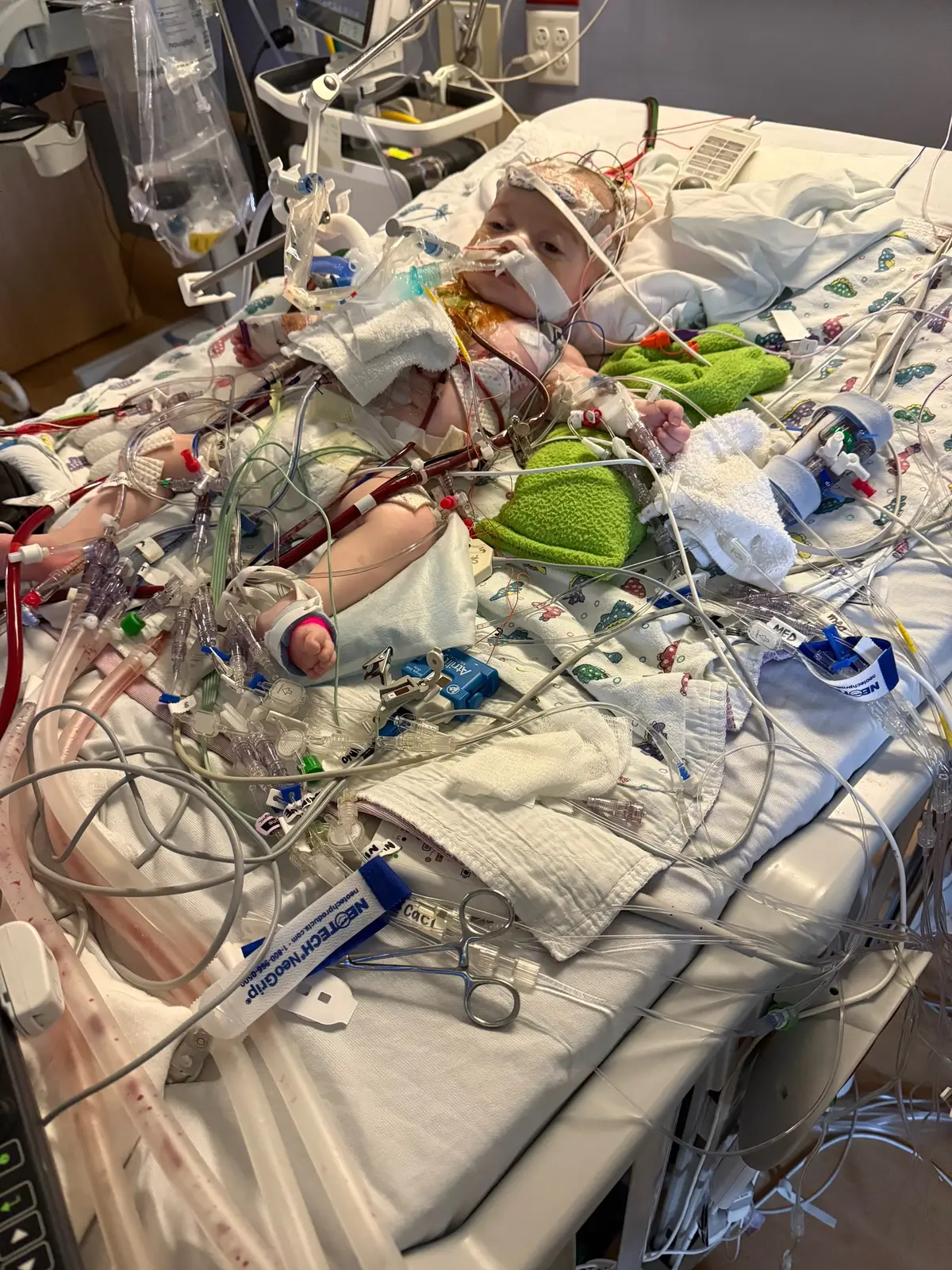 His transplant journey has been significantly difficult, it hasn’t been a healing journey yet, but one day at a time: everyday is some new findings. I hate having to see my boy like this, I wish I could hold him, and give him lovings.  When you see him look right at you, in pain and discomfort, you feel helpless and discouraged. You want to help but can’t, you want him to heal and get better, but his battle has been so hard for him. Every system in his body has taken a hit in a different way.  You never want to give up, you want to keep going and hope for better days, but today, we continue to fight hard to heal and get better.  #chd #chdawarness #heartwarrior #picu #god #godisreal #chdwarrior #chdawarness #hearttransplant  #nevergiveup 