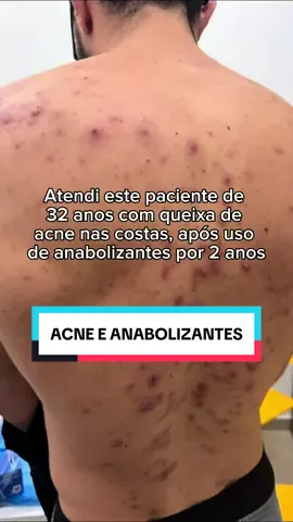 🔍💪 Histórias de luta vão além do tatame! Atendi um lutador de jiu-jitsu de 32 anos que, após 2 anos utilizando anabolizantes, está enfrentando uma grave acne inflamatória nas costas. 💥✨ A conexão entre o uso de esteroides e problemas de pele é real! É fundamental se informar e cuidar da saúde. Não deixe que o desejo de performance prejudique seu bem-estar.  #Acne #Anabolizantes #Saúde #JiuJitsu #CuidadosComAPele #Esteroides #Consciência #SaúdeÉPrioridade #espinhas #espinhasnascostas 