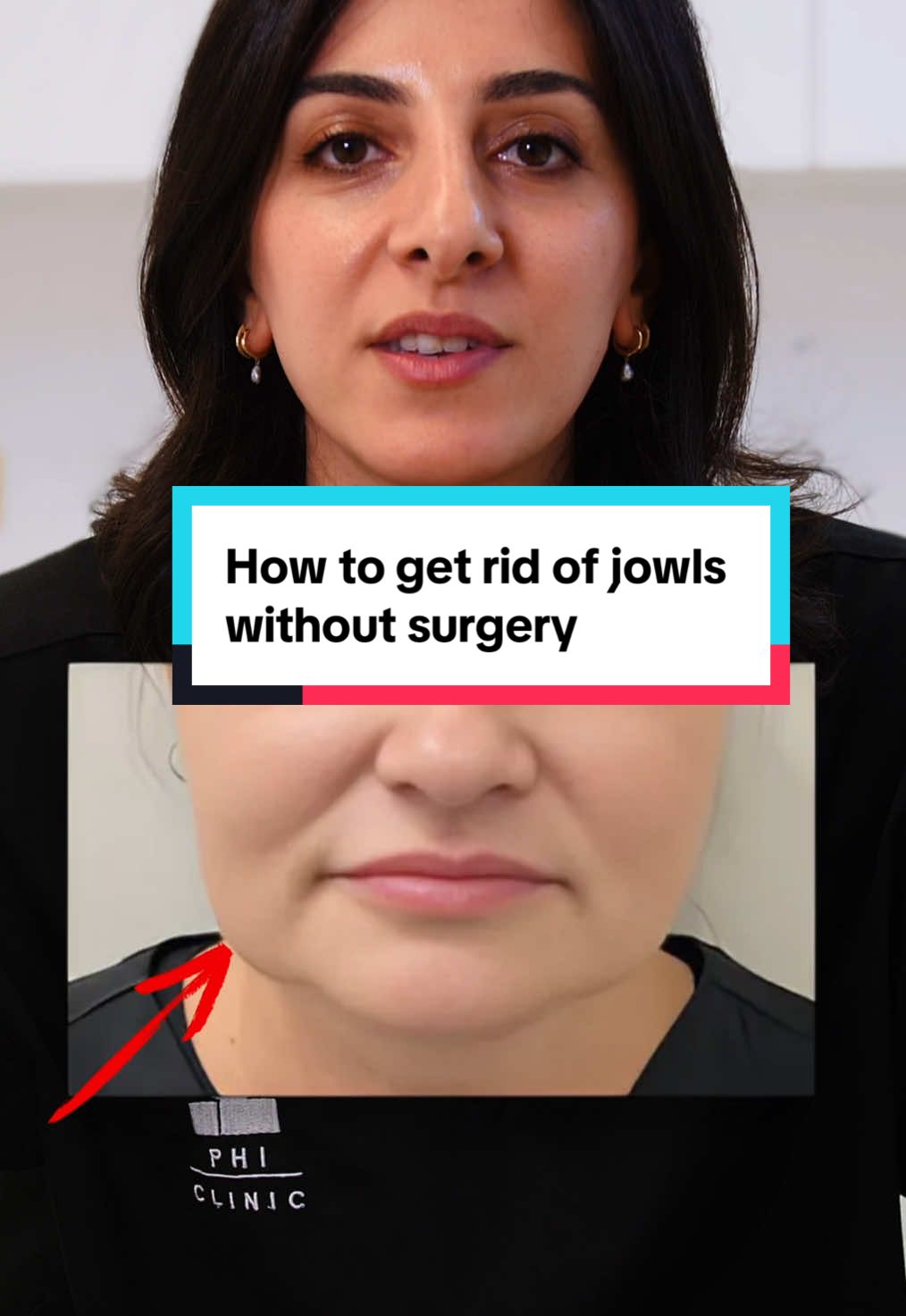 Did you know you can get rid of jowls without surgery? Watch this video to find out how. Do you have any questions about endolift? Leave them in the comments and we’ll answer them in the next video ☺️ #jowls #jowlstreatment #jowlsreduction #endolift #phiclinic 