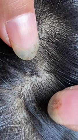😱😱#omg #lice #liceremoval 