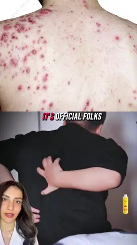 Years of back acne?The real cause might surprise you #backacne #acnetreatmen #dryskin #bodywash #cozyvibes #eagffortlessbesuty #mite #tiktok #tiktokshop 