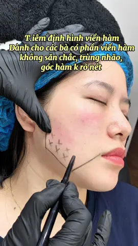 Botox giúp săn chắc định hình viền hàm <3 