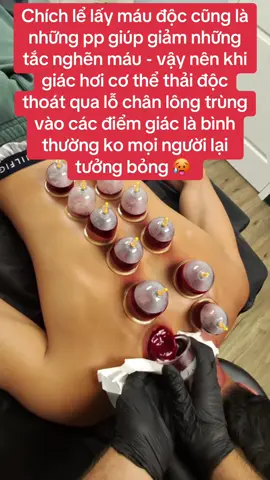 Chích lể lấy máu độc cũng là những pp giúp giảm những tắc nghẽn máu - vậy nên khi giác hơi cơ thể thải độc thoát qua lỗ chân lông trùng vào các điểm giác là bình thường ko mọi người lại tưởng bỏng 🥵 #duongsinhhabang #chamsocsuckhoe #hungyen #hoccungtiktok 