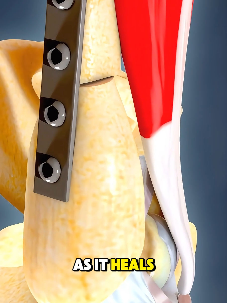 How Periacetabular Osteotomy Surgery Is Performed (3D Animation) #periacetabularosteotomy  #3dmedicalanimation  #medical3danimation  #hipdysplasia  #hippreservation  #bonehealth #jointhealth #medicalawareness  #orthopedics  #postsurgeryrecovery  #orthopedicsurgery  #hipdysplasiaawareness 