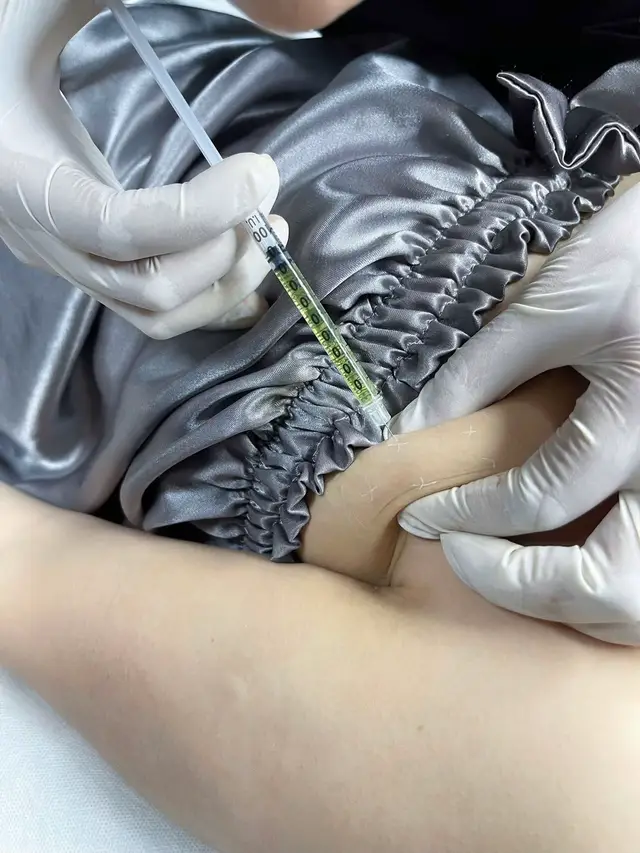 Tiêm tan mỡ nách là một phương pháp thẩm mỹ không phẫu thuật nhằm giảm lượng mỡ thừa ở vùng nách bằng cách tiêm các hoạt chất có khả năng phá vỡ tế bào mỡ 
