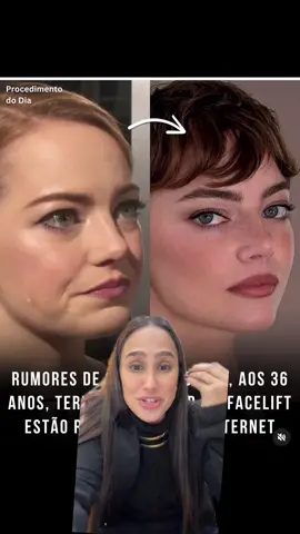 O novo rosto de Emma Stone. Gostou ? #estrticafacial #papada #harmonizacaofacial