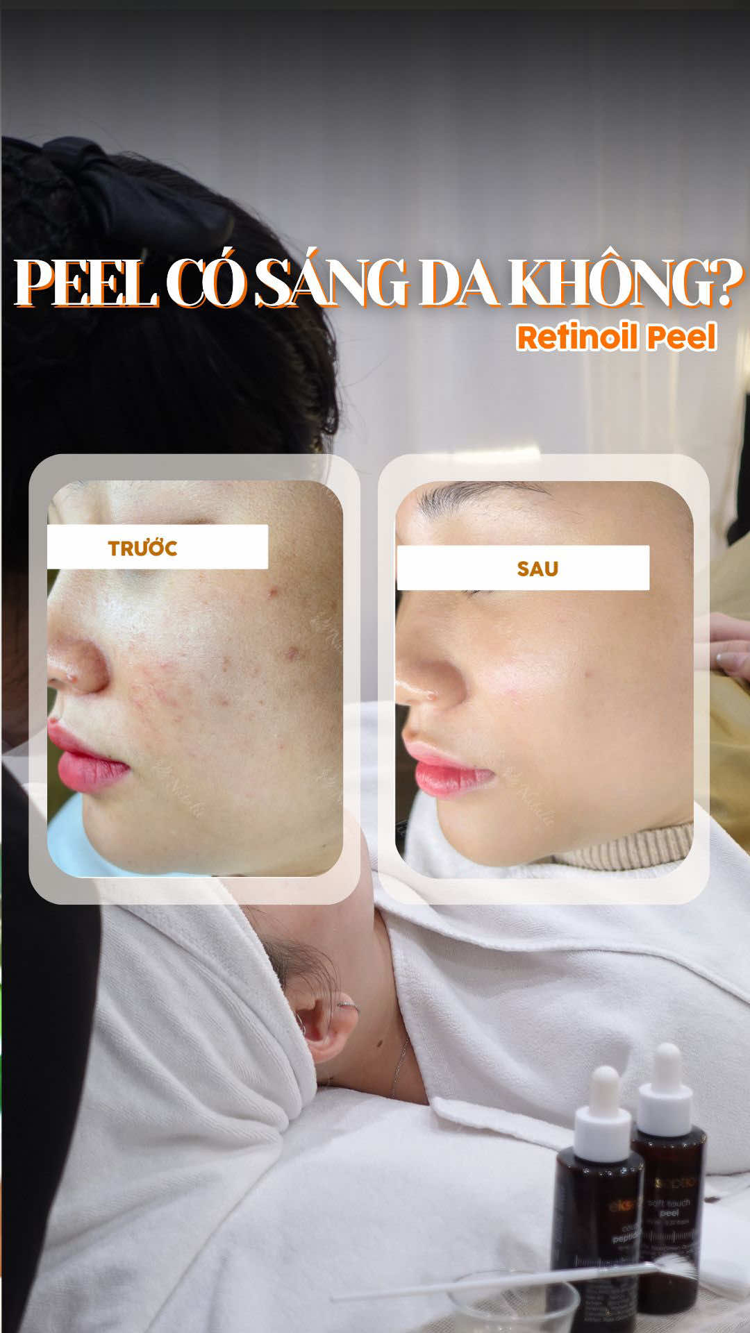 Peel da không chỉ xử lý mụn mà còn mờ thâm, sáng da. Các bác đã thử chưa? #nataliebeauty #BeautyTok #peel #peelda #xuhuong 