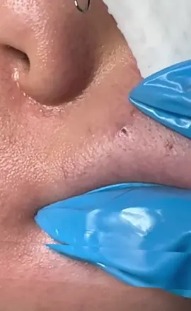 Extration blackhead #blackhead #pimples #blackheads #comfortable 