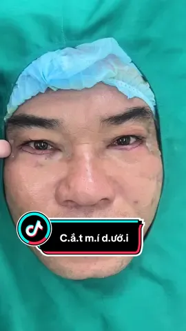 Bọng mắt, da dư thù c.ắt mi.í dưới nhé mấy ac #treocungchanmay #nangmuicautruc #nângmũi #nhấnmí #cắtmíđẹp #tik_tok #xuhuong #mí #viral #trend #catmi #málumđôngtien 