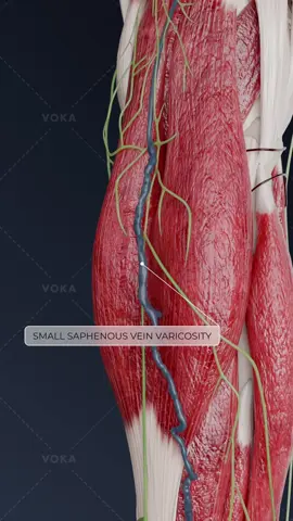 What is varicosity of the superficial veins and how can it impact your health?   Varicostilation (varicosity) of the superficial veins is a chronic condition caused by valve dysfunction and decreased venous wall tone. This leads to venous hypertension, causing vein dilation, tortuosity, blood stasis, edema, and pain.   If left untreated, varicosity can progress to more severe complications: 🔻 Thrombophlebitis – inflammation of the veins, which can cause blood clots, leading to additional risks. 🔻 Trophic disorders – poor circulation can lead to skin changes, ulcers, and other serious conditions.   Understanding the stages and progression of varicosity can help prevent complications and improve treatment outcomes.   📌 Dive deeper into the anatomy of venous diseases and explore varicosity in 3D with VOKA 3D Anatomy & Pathology!   #varicoseveins #thrombophlebitis #vascularhealth #vasculardiseases #3D #3Danimation #3Dmedicalanimation #3danatomy #medstudents #medicaleducation #anatomy #pathology #3danatomy #digitallearning #humanbody 