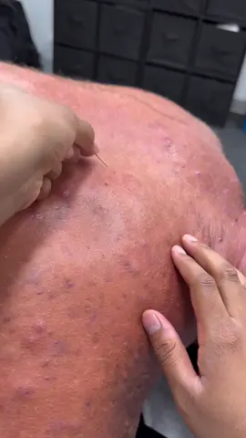 O agulhamento a seco (ou dry needling) é uma técnica terapêutica utilizada principalmente por fisioterapeutas, que consiste na inserção de agulhas finas (sem medicação ou substância) em pontos gatilho musculares, com o objetivo de aliviar dor e tensões musculares. Para que serve: 	•	Redução da dor miofascial 	•	Liberação de pontos gatilho 	•	Melhora da amplitude de movimento 	•	Relaxamento muscular 	•	Estímulo da regeneração tecidual Associação com Eletroterapia (Eletro Dry Needling): A combinação do agulhamento com corrente elétrica de baixa frequência (geralmente TENS ou corrente farádica) intensifica os efeitos terapêuticos. A estimulação elétrica é aplicada diretamente nas agulhas, promovendo: 	•	Maior ativação neuromuscular 	•	Analgesia mais duradoura 	•	Redução mais eficiente do tônus muscular 	•	Melhora da circulação local Indicações comuns: 	•	Dor lombar ou cervical crônica 	•	Síndrome miofascial 	•	Tendinites e bursites 	•	Espasmos musculares 	•	Disfunções musculoesqueléticas em geral Contraindicações: 	•	Gestantes (em áreas específicas) 	•	Pessoas com fobia de agulha 	•	Pacientes com marca-passo (no caso de eletroterapia) 	•	Infecções locais ou distúrbios de coagulação #fisioterapia #fisioterapeuta #dryneedling #eletroestimulação 