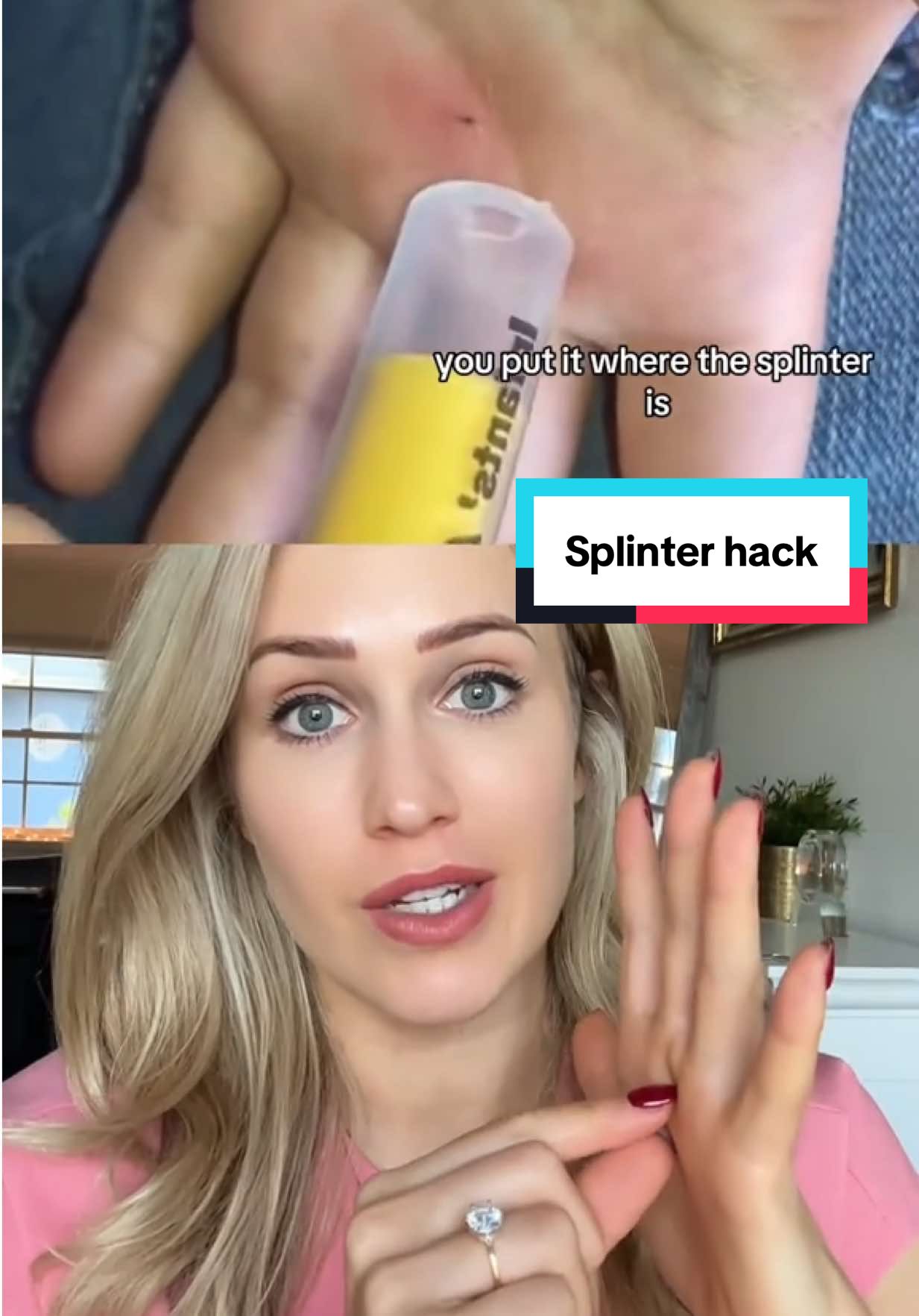 You need to know this life hack! 🎥 @t_timecreations #splinter #LifeHack #splinterremoval #doctor